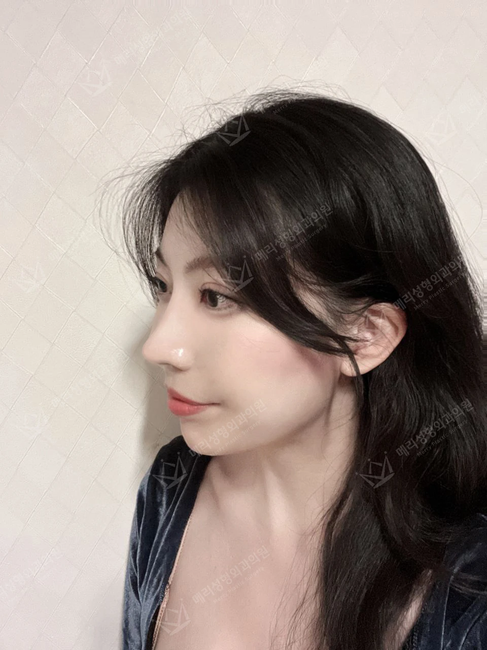 Revision eyelid surgery, rhinoplasty and two Liftera sessions at Merry Plastic Surgery Clinic. Merry Plastic Surgery, Seoul: revision eyelid surgery, rhinoplasty and two liftera sessions, one month after surgery, photograph.