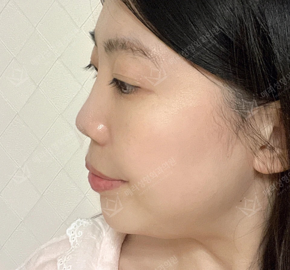 Revision eyelid surgery, rhinoplasty and two Liftera sessions at Merry Plastic Surgery Clinic. Merry Plastic Surgery, Seoul: revision eyelid surgery, rhinoplasty and two liftera sessions, before treatment, photograph.