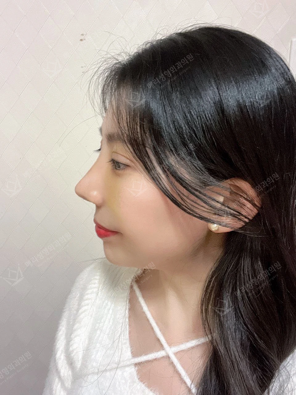 Revision eyelid surgery, rhinoplasty and two Liftera sessions at Merry Plastic Surgery Clinic. Merry Plastic Surgery, Seoul: revision eyelid surgery, rhinoplasty and two liftera sessions, one week after surgery, photograph.