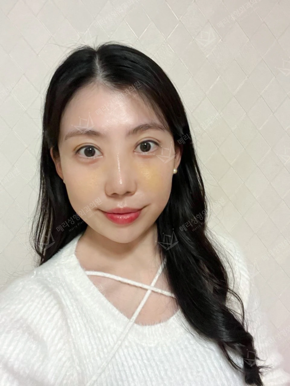 Revision eyelid surgery, rhinoplasty and two Liftera sessions at Merry Plastic Surgery Clinic. Merry Plastic Surgery, Seoul: revision eyelid surgery, rhinoplasty and two liftera sessions, one week after surgery, photograph.