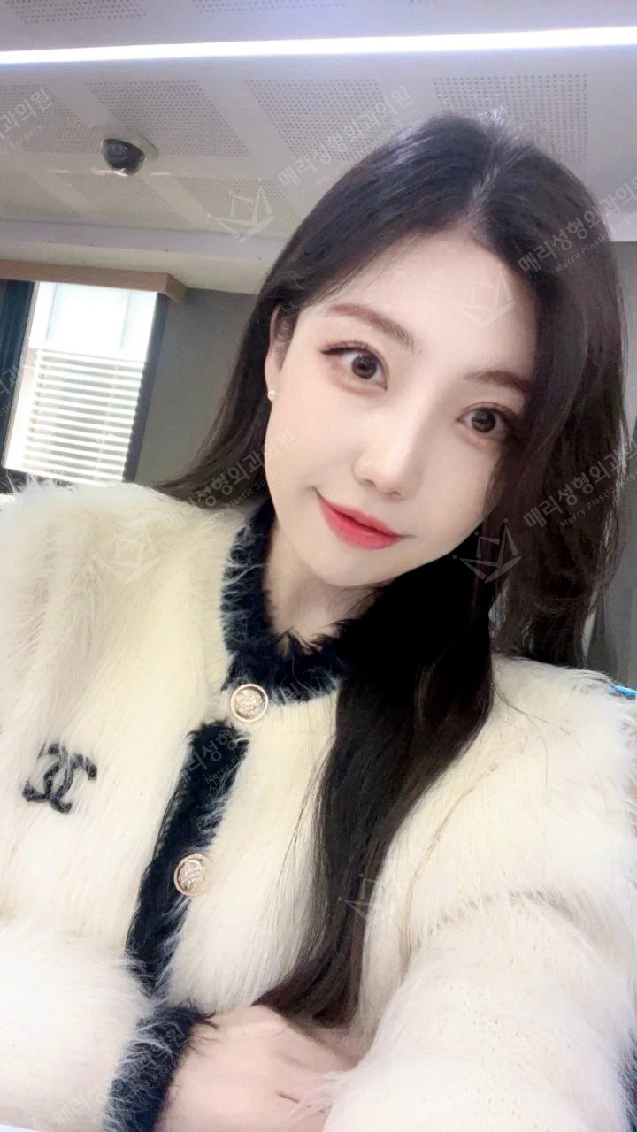 Revision eyelid surgery, rhinoplasty and two Liftera sessions at Merry Plastic Surgery Clinic. Merry Plastic Surgery, Seoul: revision eyelid surgery, rhinoplasty and two liftera sessions, one month after surgery, photograph.