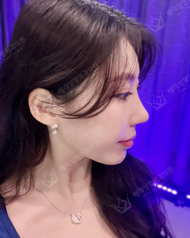 Revision eyelid surgery, rhinoplasty and two Liftera sessions at Merry Plastic Surgery Clinic. Merry Plastic Surgery, Seoul: revision eyelid surgery, rhinoplasty and two liftera sessions, one month after surgery, photograph.