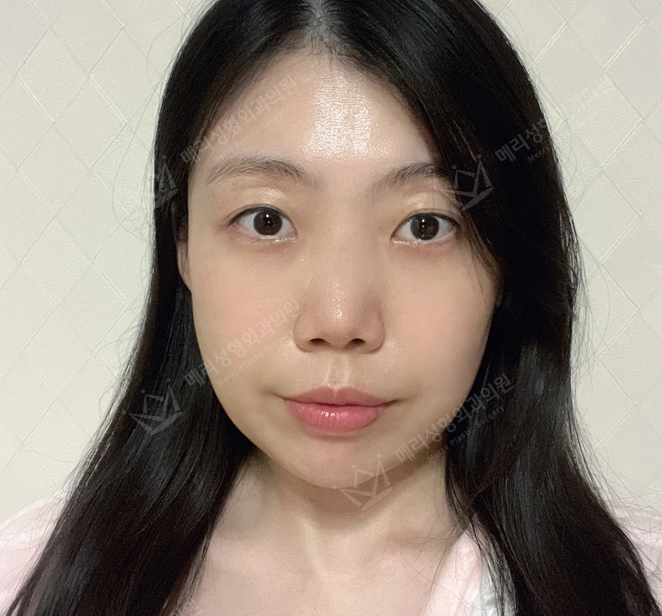 Revision eyelid surgery, rhinoplasty and two Liftera sessions at Merry Plastic Surgery Clinic. Merry Plastic Surgery, Seoul: revision eyelid surgery, rhinoplasty and two liftera sessions, before treatment, photograph.