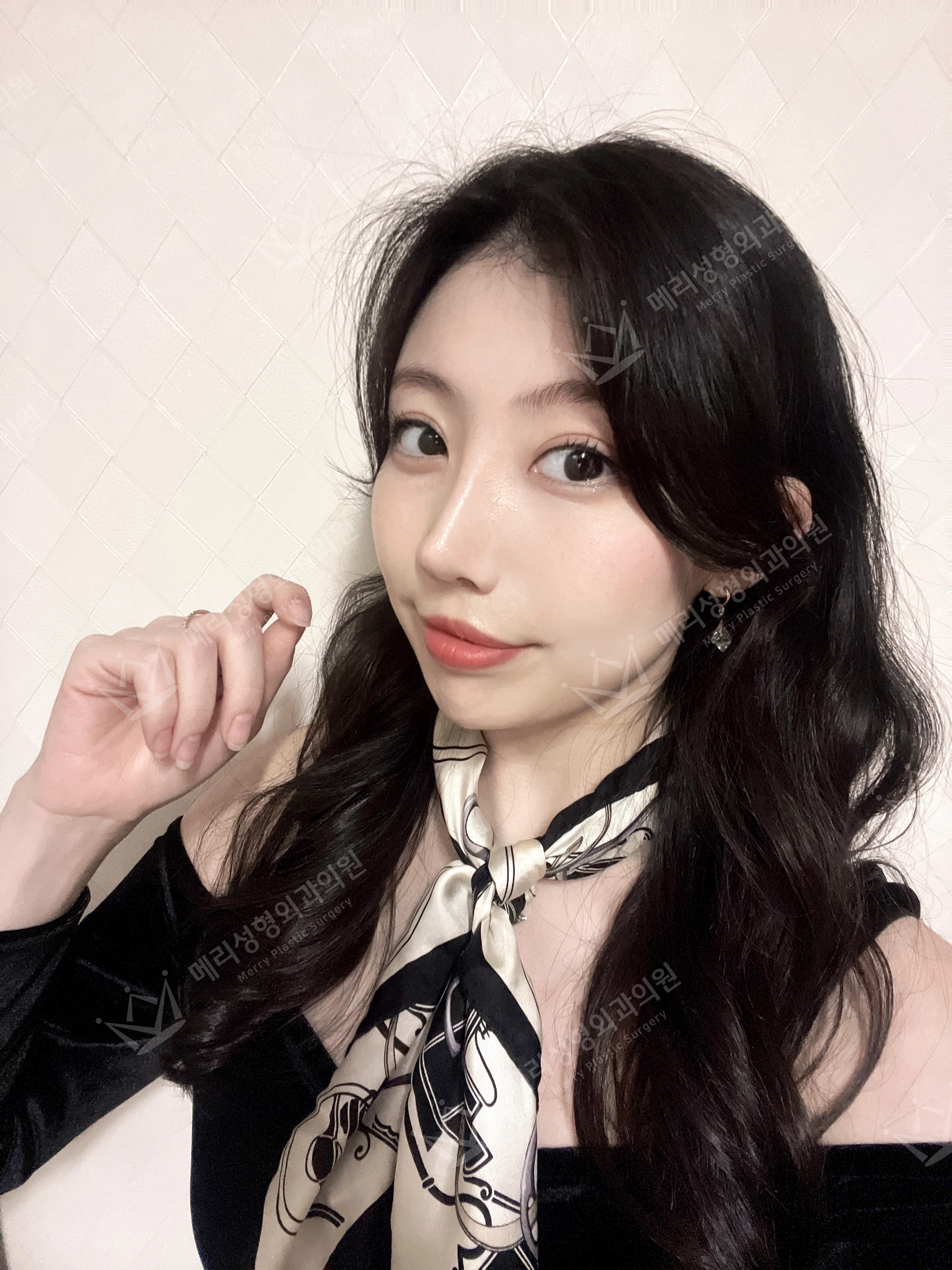 Revision eyelid surgery, rhinoplasty and two Liftera sessions at Merry Plastic Surgery Clinic. Merry Plastic Surgery, Seoul: revision eyelid surgery, rhinoplasty and two liftera sessions, one month after surgery, photograph.