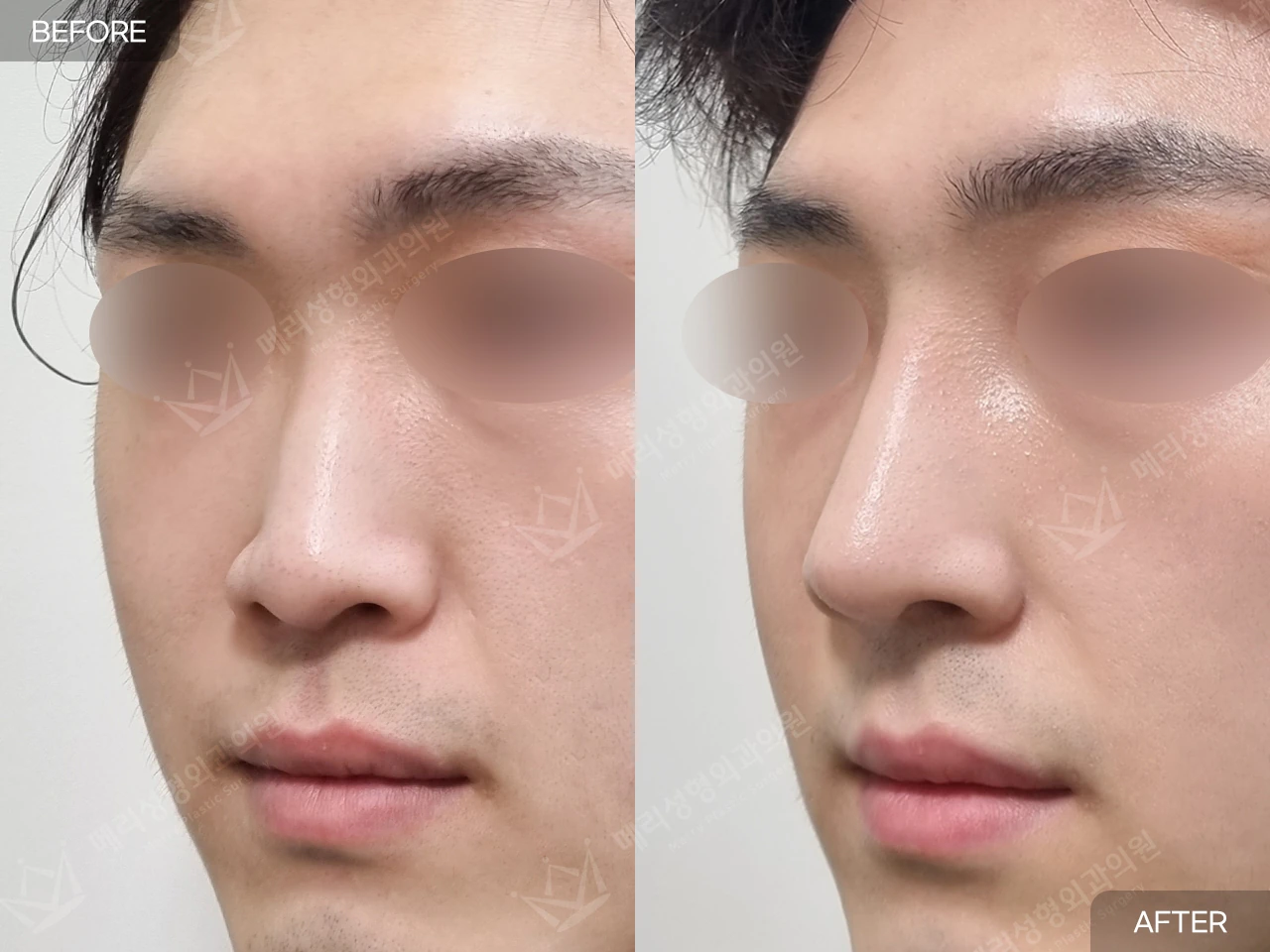 Functional rhinoplasty with hump correction at Merry Plastic Surgery Clinic. Merry Plastic Surgery, Seoul: functional rhinoplasty with hump correction — oblique view, before and after comparison.