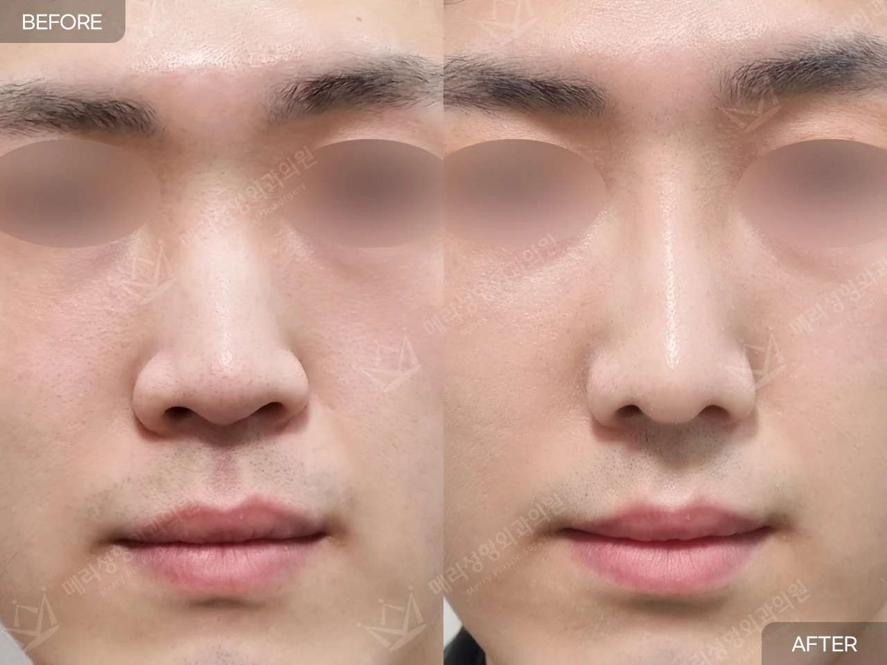 Functional rhinoplasty with hump correction at Merry Plastic Surgery Clinic. Merry Plastic Surgery, Seoul: functional rhinoplasty with hump correction — front view, before and after comparison.