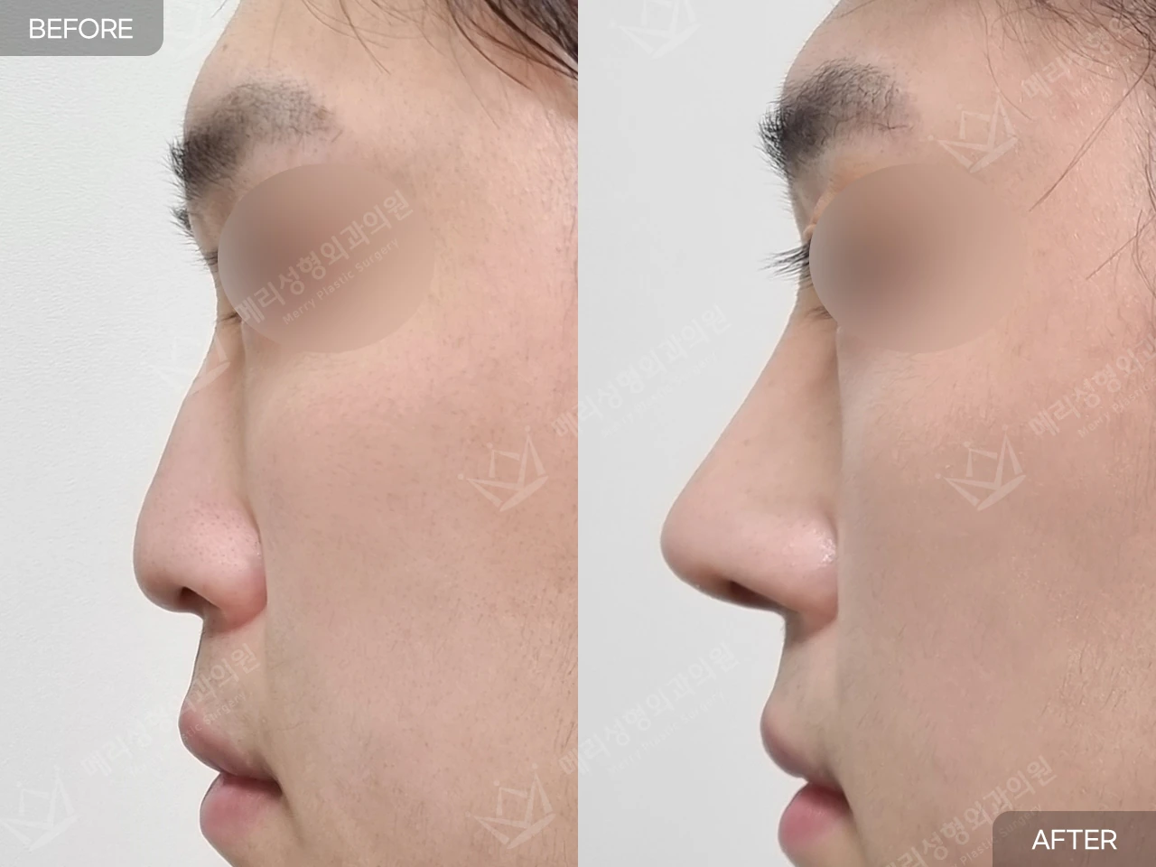 Functional rhinoplasty with hump correction at Merry Plastic Surgery Clinic. Merry Plastic Surgery, Seoul: functional rhinoplasty with hump correction — side profile, before and after comparison.