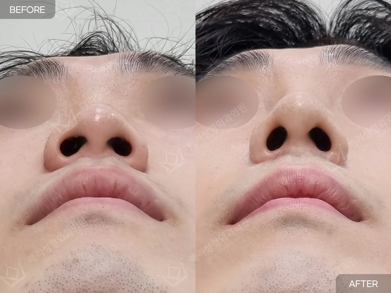Functional rhinoplasty with hump correction at Merry Plastic Surgery Clinic. Merry Plastic Surgery, Seoul: functional rhinoplasty with hump correction — underside view of the nostrils, before and after comparison.