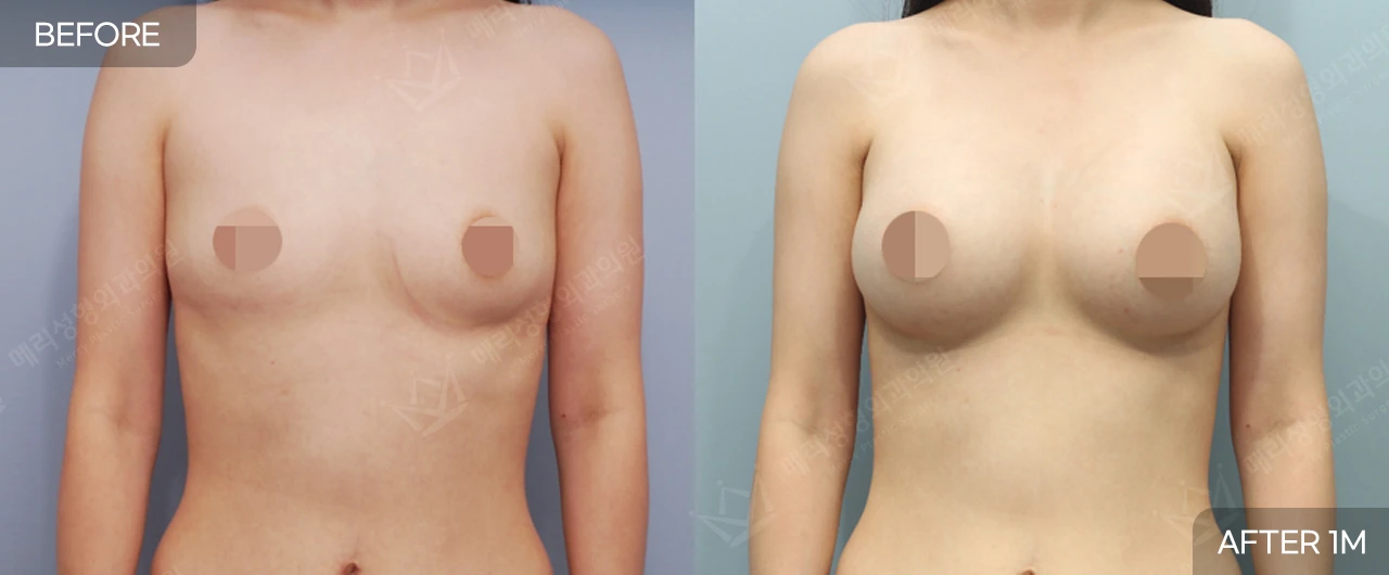 Breast surgery: front and oblique comparisons at Merry Plastic Surgery Clinic. Merry Plastic Surgery, Seoul: breast surgery — front view of the breasts, before and after comparison, 1 month follow-up.