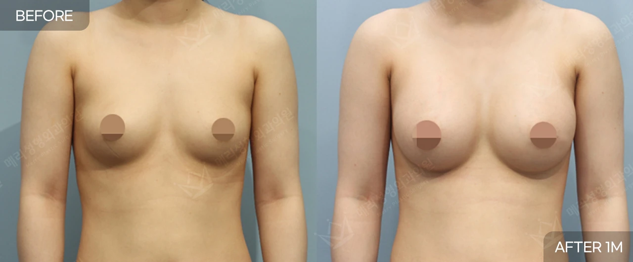 Breast surgery: one-month comparison at Merry Plastic Surgery Clinic. Merry Plastic Surgery, Seoul: breast surgery — front view of the breasts, before and after comparison, 1 month follow-up.