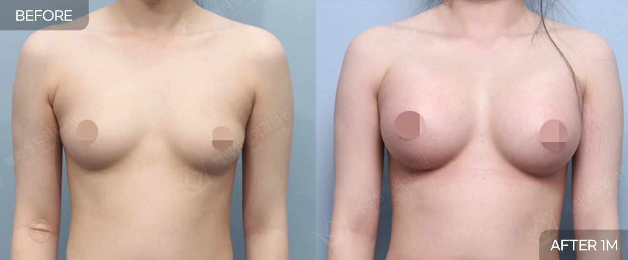 Breast surgery: front and side comparison at Merry Plastic Surgery Clinic. Merry Plastic Surgery, Seoul: breast surgery — front view of the breasts, before and after comparison, 1 month follow-up.