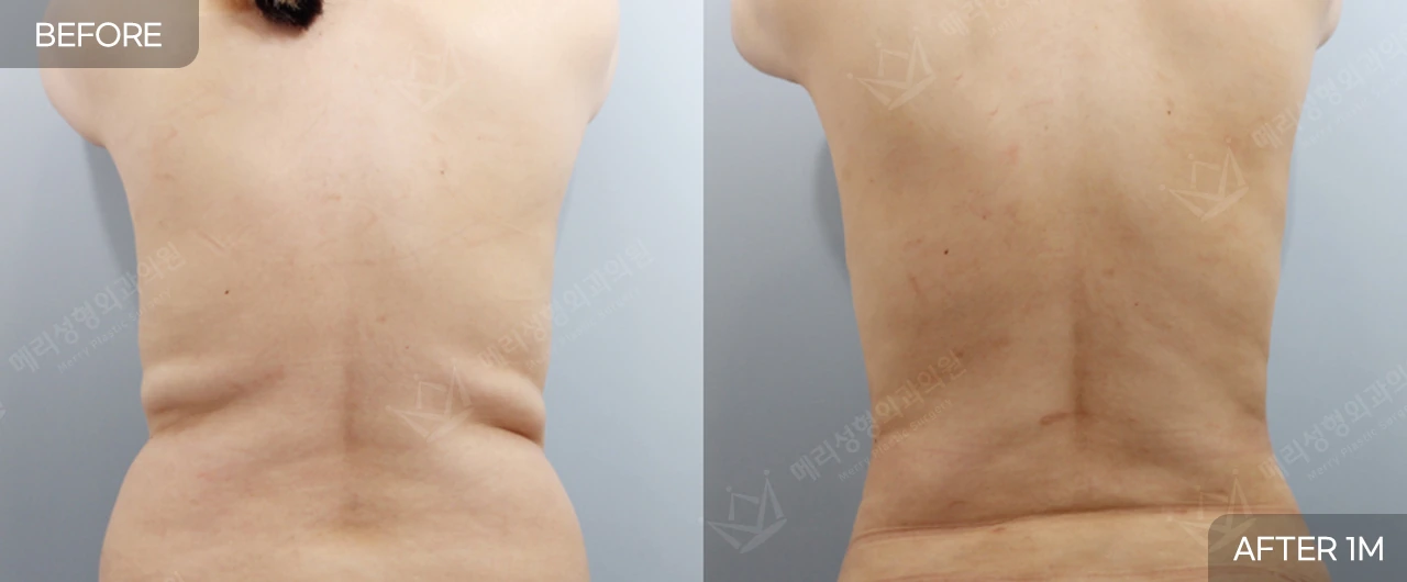 Abdomen and waist liposuction at Merry Plastic Surgery Clinic. Merry Plastic Surgery, Seoul: abdomen and waist liposuction — back view of the waist and flanks, before and after comparison, 1 month follow-up.