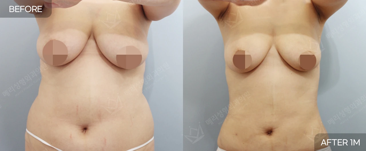 Abdomen and waist liposuction at Merry Plastic Surgery Clinic. Merry Plastic Surgery, Seoul: abdomen and waist liposuction — front view of the abdomen and waist, before and after comparison, 1 month follow-up.