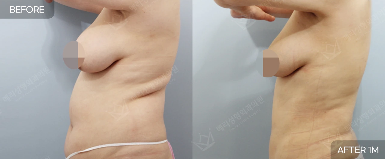 Abdomen and waist liposuction at Merry Plastic Surgery Clinic. Merry Plastic Surgery, Seoul: abdomen and waist liposuction — side view of the abdomen and waist, before and after comparison, 1 month follow-up.