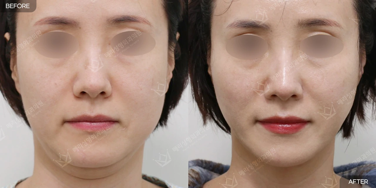 Thread lifting: front-view comparison 1 at Merry Plastic Surgery Clinic. Front-facing photographs supplied by Merry Plastic Surgery in Seoul, presented by the clinic as a before-and-after thread-lifting comparison.