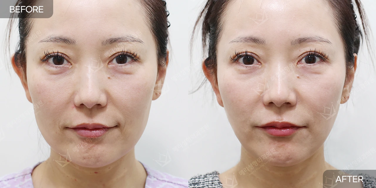 Thread lifting: front-view comparison 2 at Merry Plastic Surgery Clinic. Front-facing photographs supplied by Merry Plastic Surgery in Seoul, presented by the clinic as a before-and-after thread-lifting comparison.