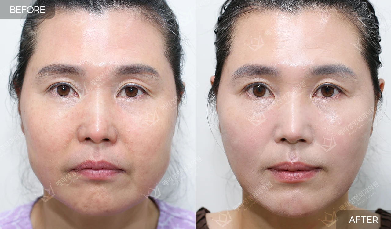 Thread lifting: front-view comparison 3 at Merry Plastic Surgery Clinic. Front-facing photographs supplied by Merry Plastic Surgery in Seoul, presented by the clinic as a before-and-after thread-lifting comparison.