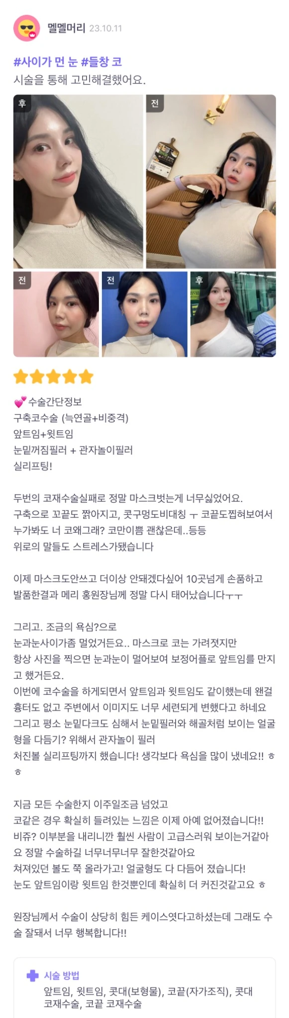 Revision rhinoplasty, canthoplasty, filler and thread lifting patient photo review — 003 at Merry Plastic Surgery Clinic. Revision rhinoplasty, canthoplasty, filler and thread lifting at Merry Plastic Surgery: before-and-after photographs shown in the supplied patient review.