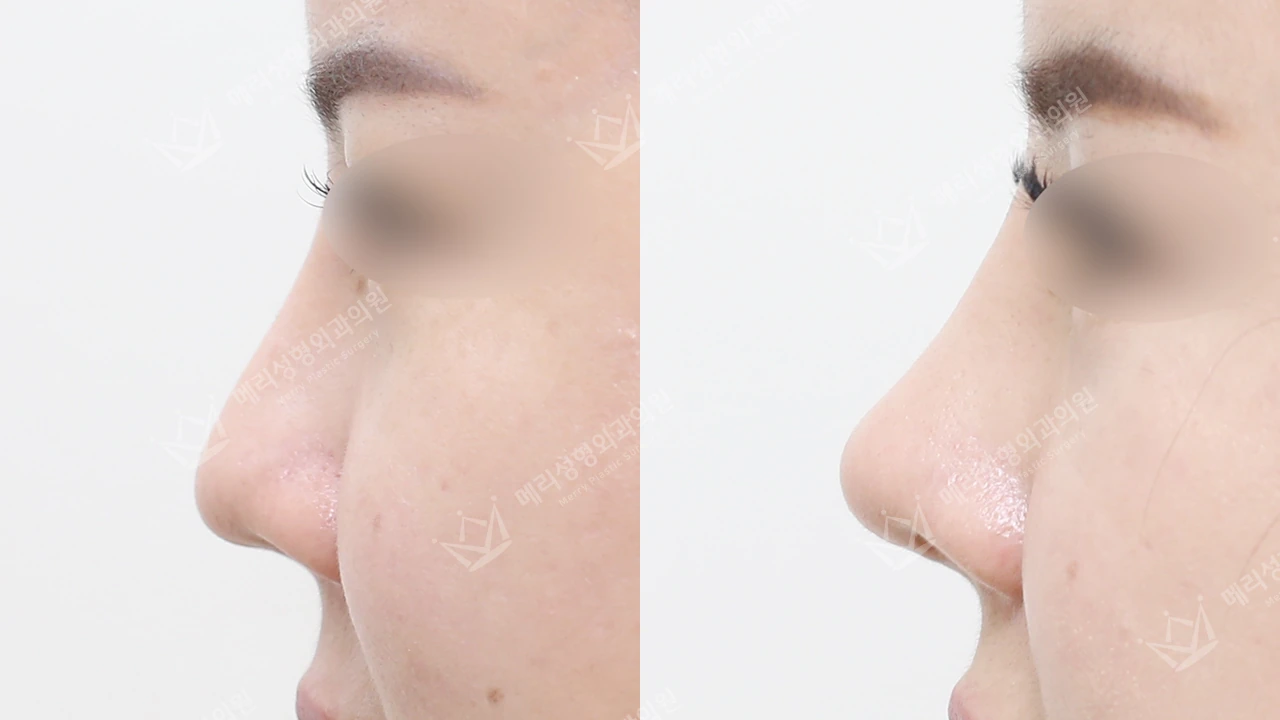 Rhinoplasty before and after: profile 1 at Merry Plastic Surgery Clinic. Merry Plastic Surgery Clinic, Seoul: Rhinoplasty, before and after comparison, view 1.