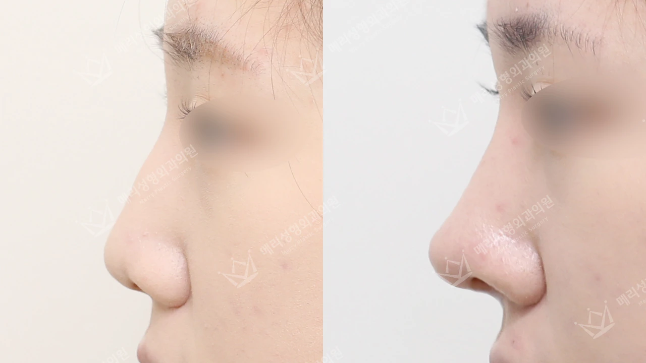 Rhinoplasty before and after: profile 2 at Merry Plastic Surgery Clinic. Merry Plastic Surgery Clinic, Seoul: Rhinoplasty, before and after comparison, view 1.