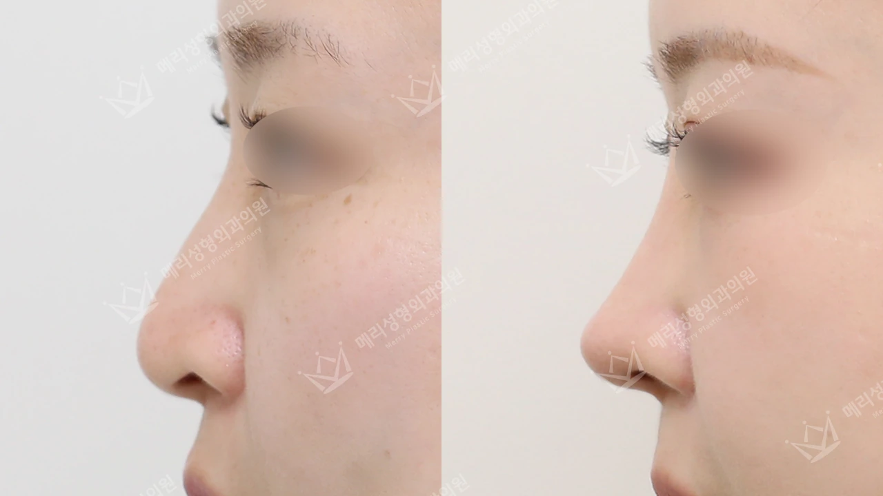 Rhinoplasty before and after: profile 3 at Merry Plastic Surgery Clinic. Merry Plastic Surgery Clinic, Seoul: Rhinoplasty, before and after comparison, view 1.