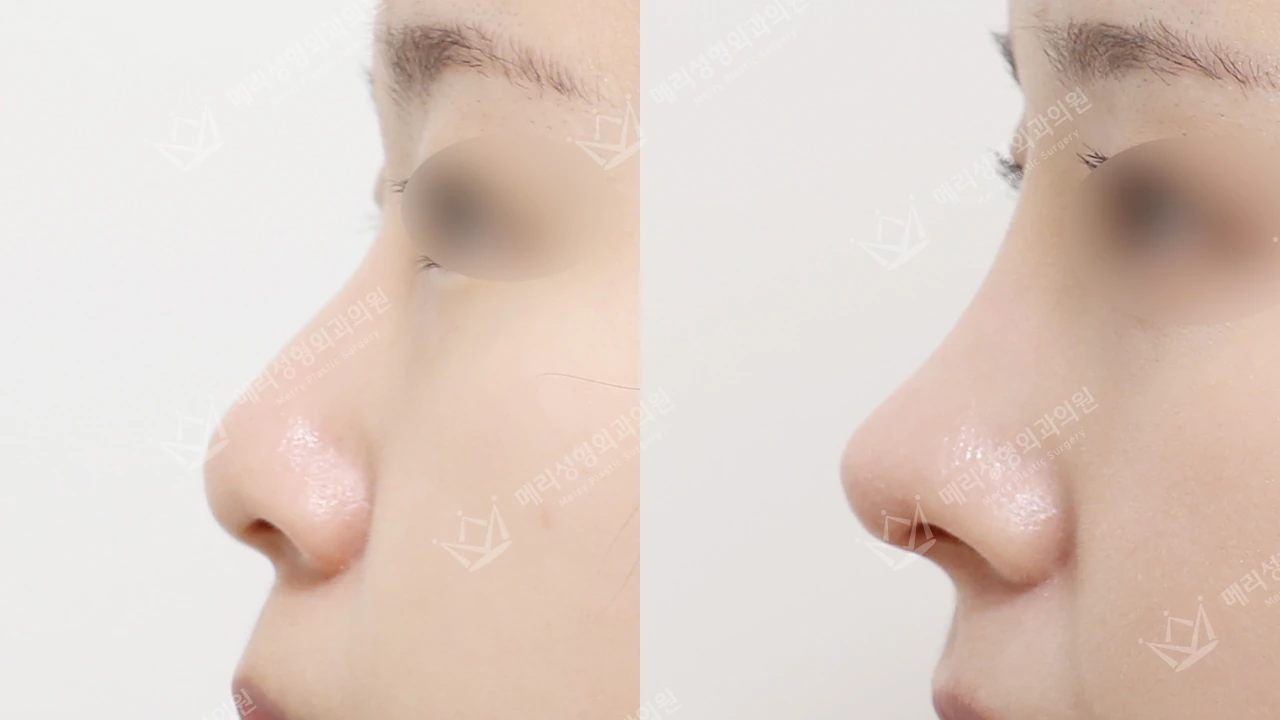 Rhinoplasty before and after: profile 4 at Merry Plastic Surgery Clinic. Merry Plastic Surgery Clinic, Seoul: Rhinoplasty, before and after comparison, view 1.