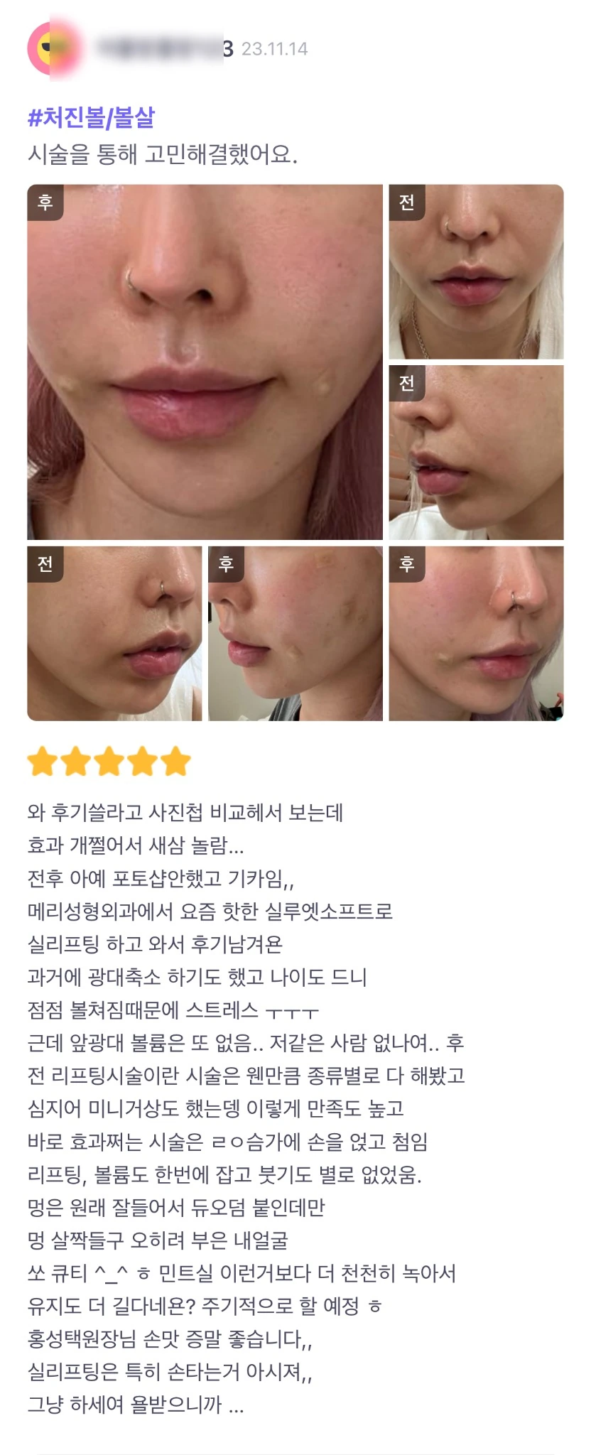 Thread lifting patient photo review — 080 at Merry Plastic Surgery Clinic. Thread lifting at Merry Plastic Surgery: before-and-after photographs shown in the supplied patient review.