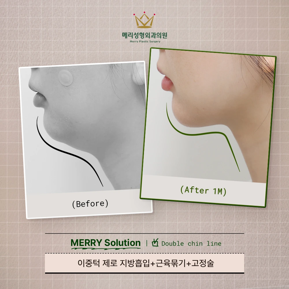 Double-chin liposuction with muscle tightening and fixation before and after — 157 at Merry Plastic Surgery Clinic. Double-chin liposuction with muscle tightening and fixation at Merry Plastic Surgery: before-and-after photographs shown in the supplied clinic comparison. The source labels the follow-up as 1 month.