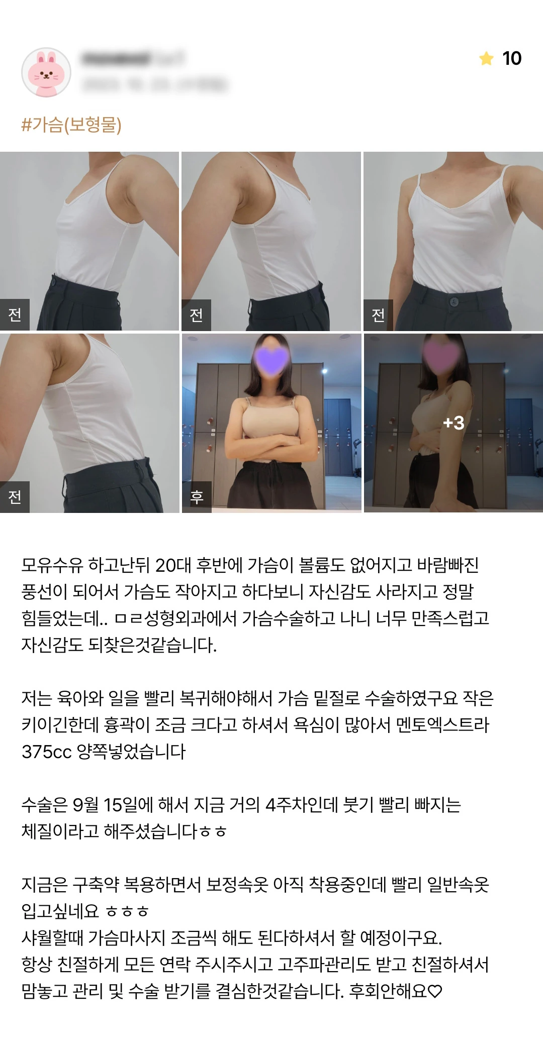 Breast augmentation patient photo review — 162 at Merry Plastic Surgery Clinic. Breast augmentation at Merry Plastic Surgery: before-and-after photographs shown in the supplied patient review. The source labels the follow-up as 4 weeks.