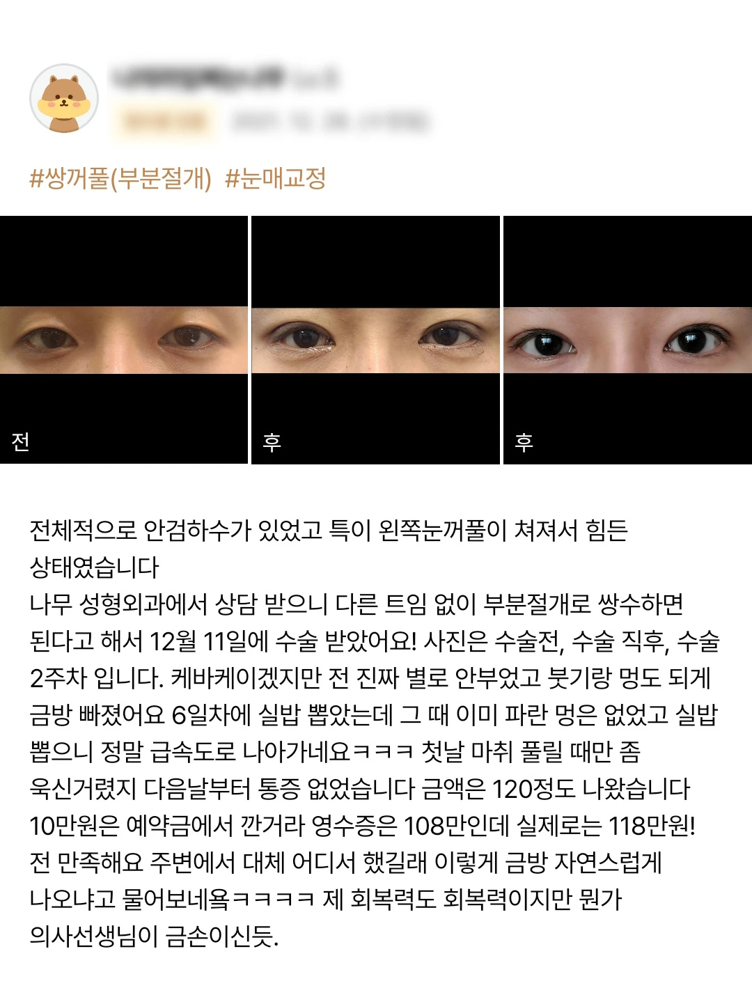 Partial-incision double-eyelid surgery and ptosis correction patient photo review — 163 at Merry Plastic Surgery Clinic. Partial-incision double-eyelid surgery and ptosis correction at Merry Plastic Surgery: before-and-after photographs shown in the supplied patient review. The source labels the follow-up as 2 weeks.