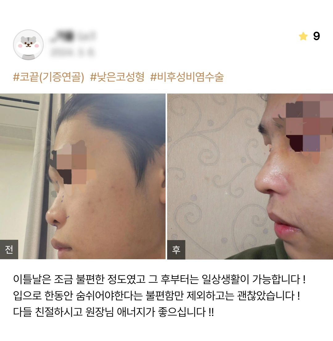 Rhinoplasty with turbinate surgery patient photo review — 167 at Merry Plastic Surgery Clinic. Rhinoplasty with turbinate surgery at Merry Plastic Surgery: before-and-after photographs shown in the supplied patient review.