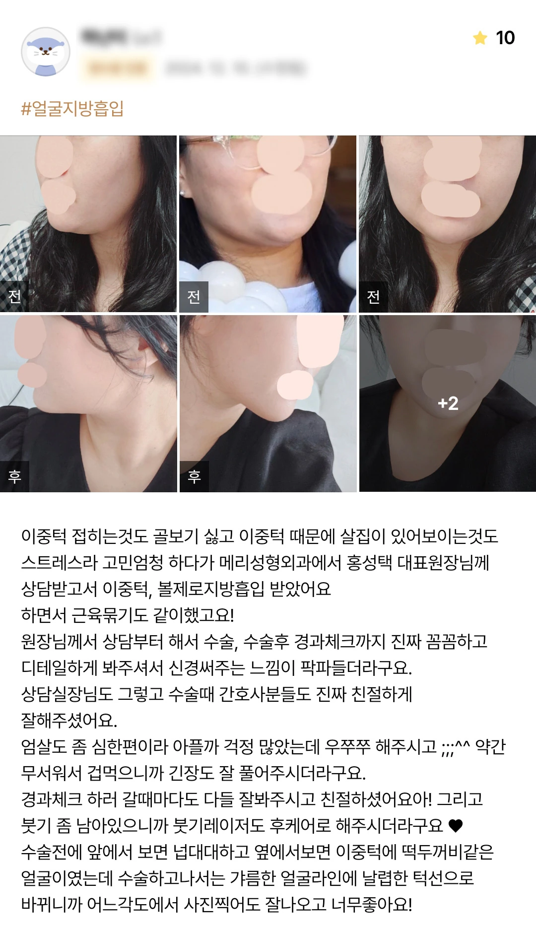 Double-chin liposuction patient photo review — 168 at Merry Plastic Surgery Clinic. Double-chin liposuction at Merry Plastic Surgery: before-and-after photographs shown in the supplied patient review.