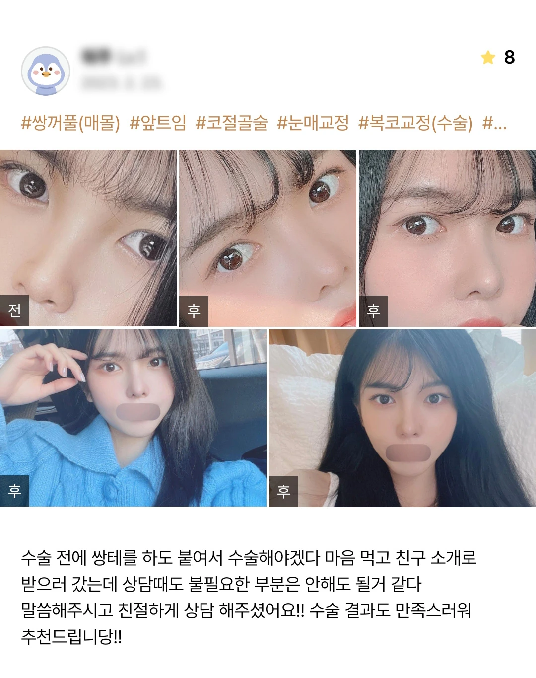 Double-eyelid surgery, canthoplasty, ptosis correction and rhinoplasty patient photo review — 169 at Merry Plastic Surgery Clinic. Double-eyelid surgery, canthoplasty, ptosis correction and rhinoplasty at Merry Plastic Surgery: before-and-after photographs shown in the supplied patient review.