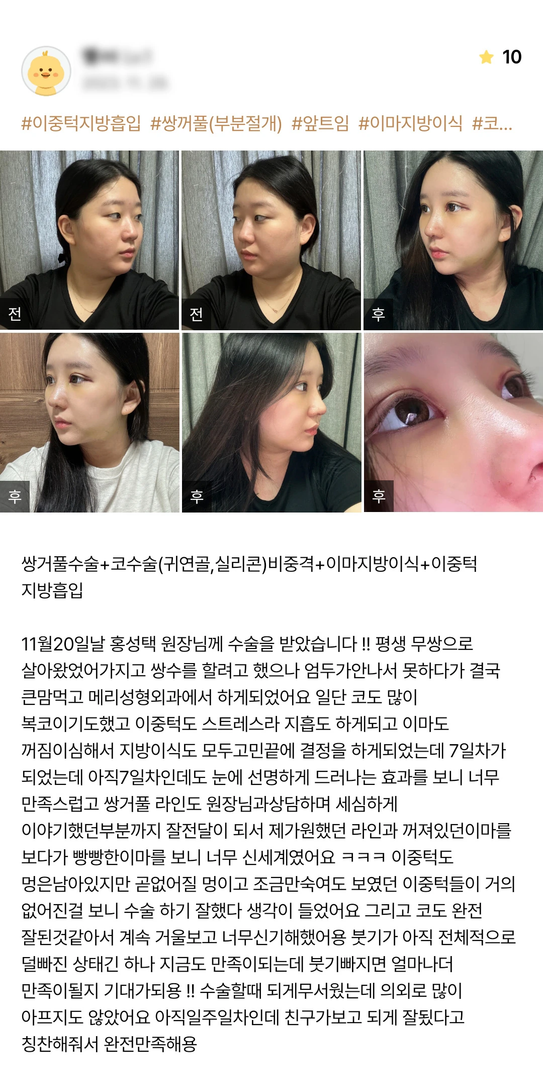 Double-eyelid surgery, rhinoplasty, forehead fat grafting and double-chin liposuction patient photo review — 170 at Merry Plastic Surgery Clinic. Double-eyelid surgery, rhinoplasty, forehead fat grafting and double-chin liposuction at Merry Plastic Surgery: before-and-after photographs shown in the supplied patient…
