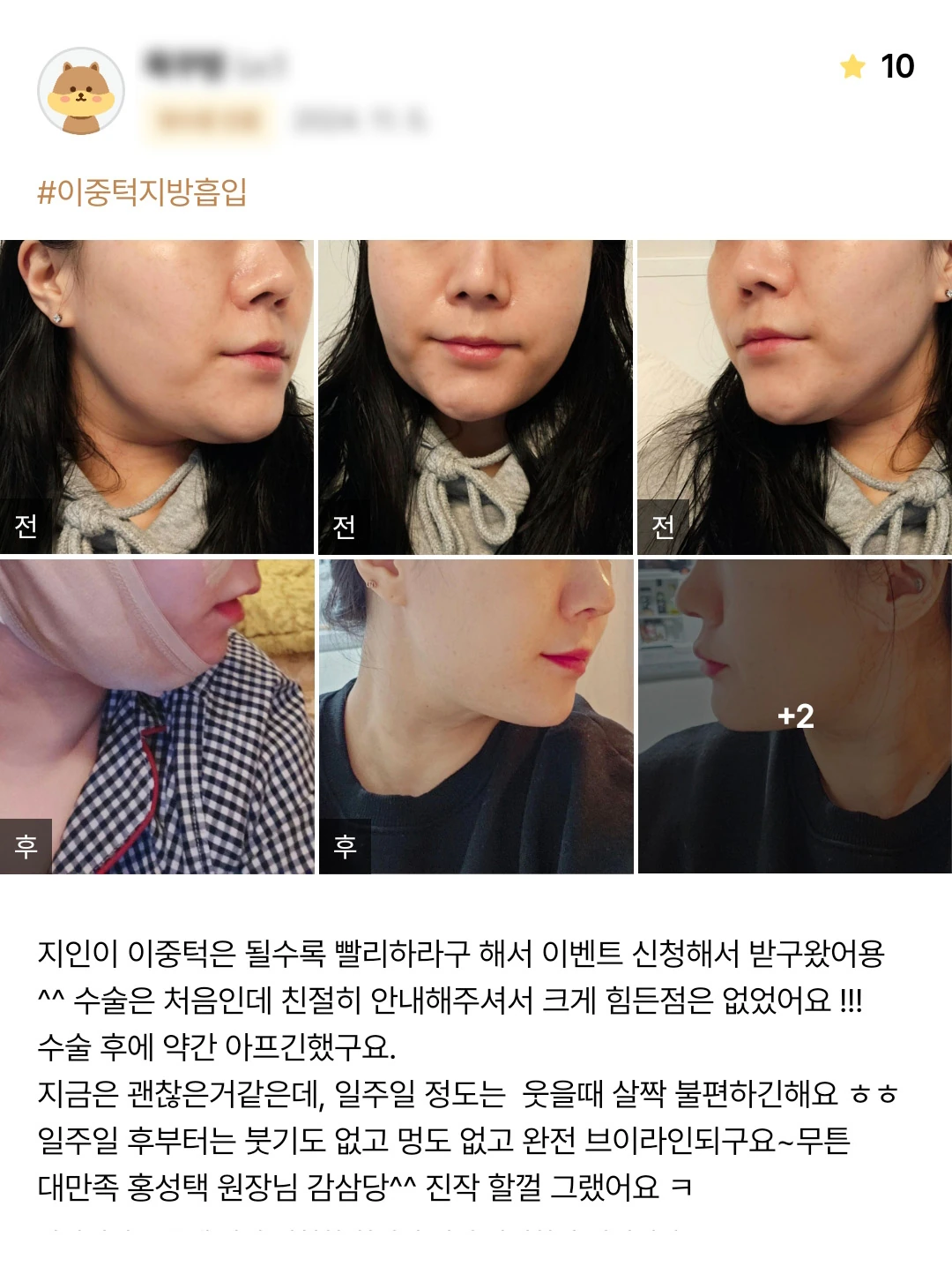 Double-chin liposuction patient photo review — 171 at Merry Plastic Surgery Clinic. Double-chin liposuction at Merry Plastic Surgery: before-and-after photographs shown in the supplied patient review.