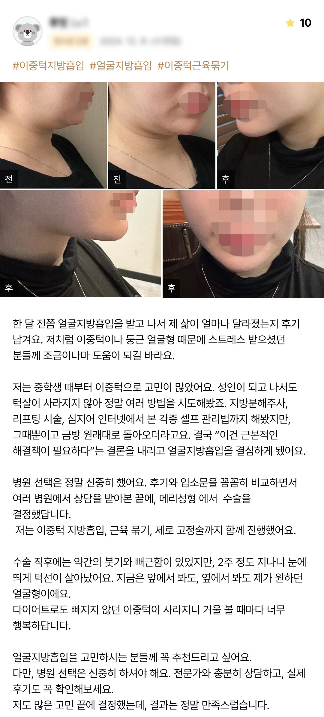 Double-chin liposuction patient photo review — 172 at Merry Plastic Surgery Clinic. Double-chin liposuction at Merry Plastic Surgery: before-and-after photographs shown in the supplied patient review.