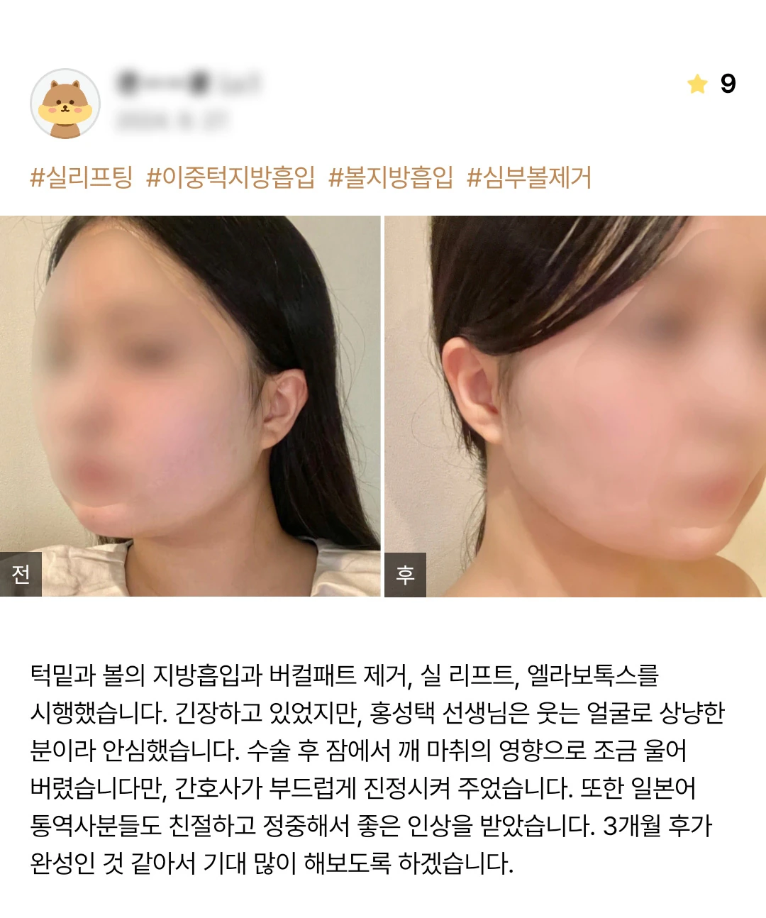 Double-chin and cheek liposuction, thread lifting and buccal fat removal patient photo review — 173 at Merry Plastic Surgery Clinic. Double-chin and cheek liposuction, thread lifting and buccal fat removal at Merry Plastic Surgery: before-and-after photographs shown in the supplied patient review.