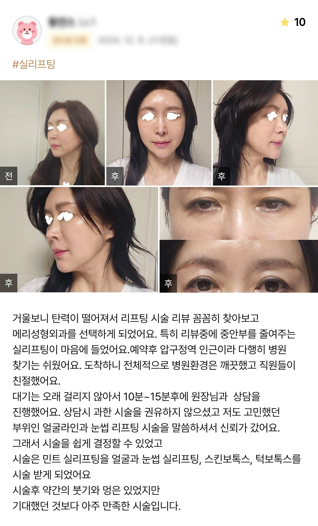 Thread lifting with botulinum toxin patient photo review — 175 at Merry Plastic Surgery Clinic. Thread lifting with botulinum toxin at Merry Plastic Surgery: before-and-after photographs shown in the supplied patient review.