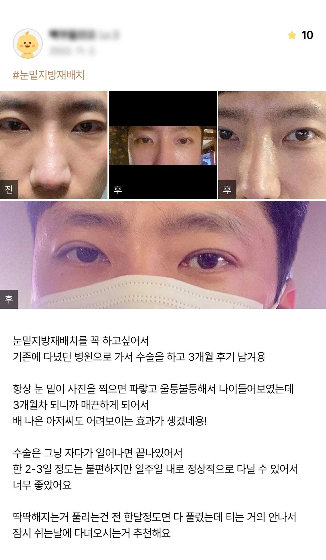 Under-eye fat repositioning patient photo review — 176 at Merry Plastic Surgery Clinic. Under-eye fat repositioning at Merry Plastic Surgery: before-and-after photographs shown in the supplied patient review. The source labels the follow-up as 3 months.