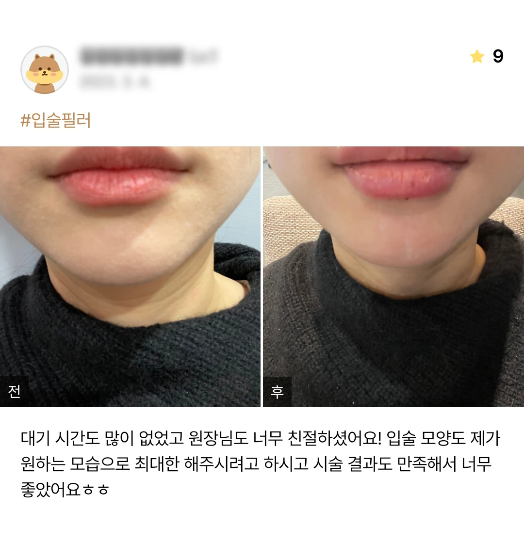 Lip filler patient photo review — 177 at Merry Plastic Surgery Clinic. Lip filler at Merry Plastic Surgery: before-and-after photographs shown in the supplied patient review.