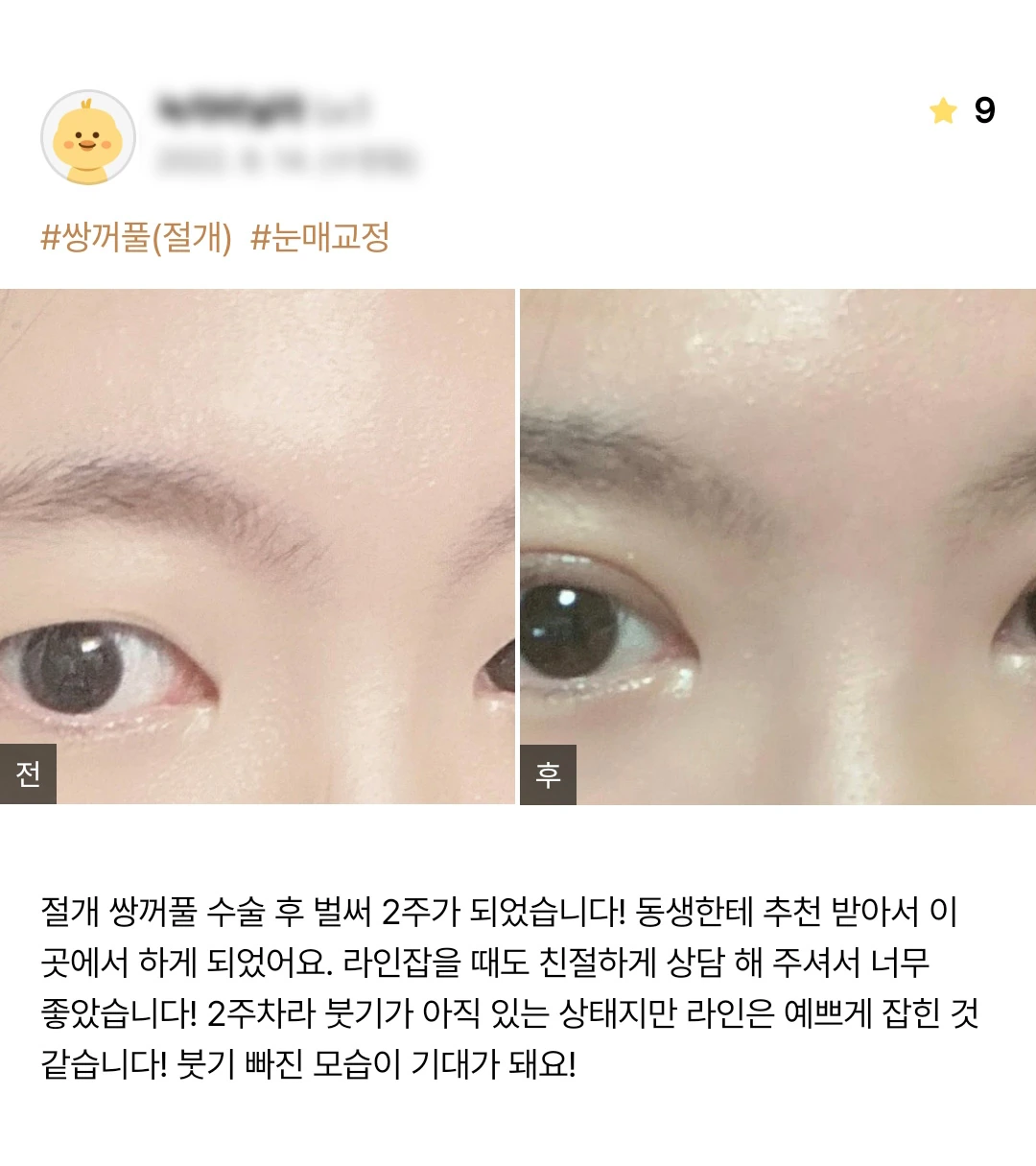 Incisional double-eyelid surgery and ptosis correction patient photo review — 179 at Merry Plastic Surgery Clinic. Incisional double-eyelid surgery and ptosis correction at Merry Plastic Surgery: before-and-after photographs shown in the supplied patient review. The source labels the follow-up as 2 weeks.