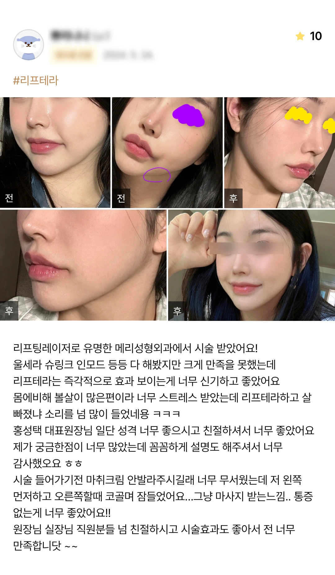 Liftera ultrasound lifting patient photo review — 180 at Merry Plastic Surgery Clinic. Liftera ultrasound lifting at Merry Plastic Surgery: before-and-after photographs shown in the supplied patient review.