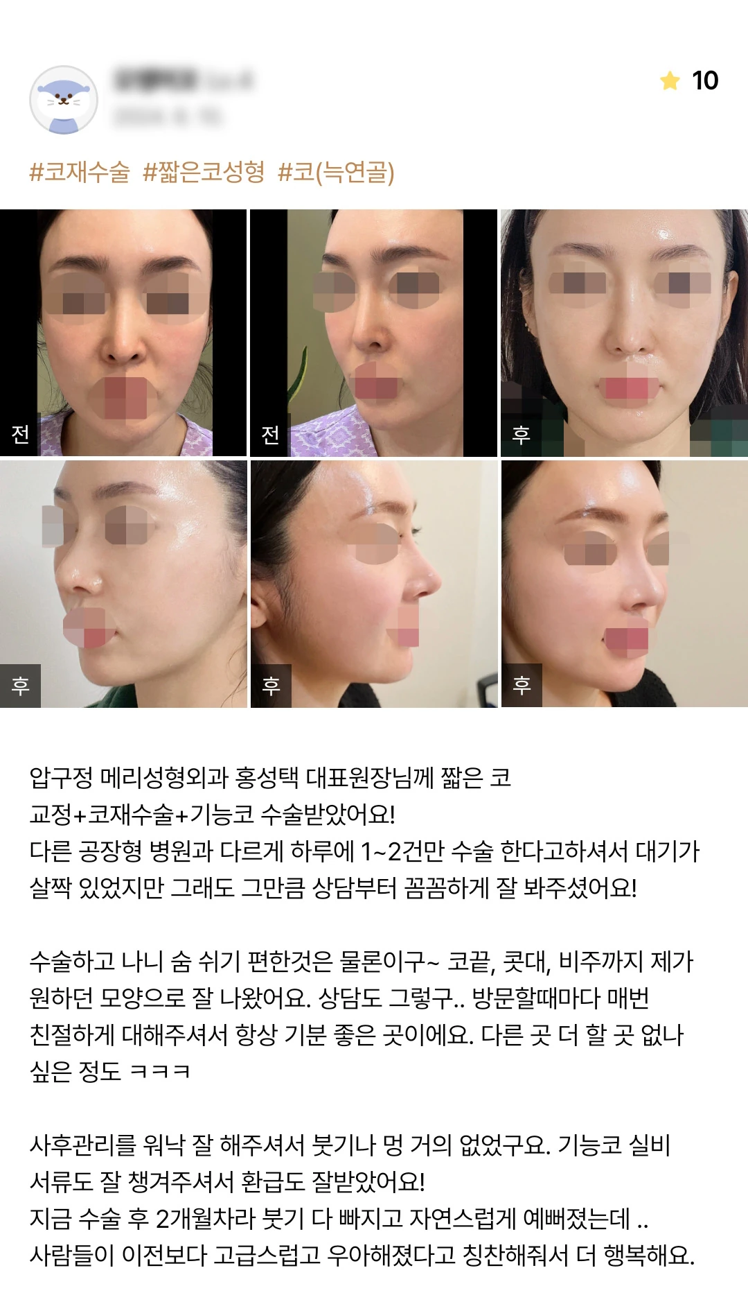 Revision and functional rhinoplasty patient photo review — 181 at Merry Plastic Surgery Clinic. Revision and functional rhinoplasty at Merry Plastic Surgery: before-and-after photographs shown in the supplied patient review. The source labels the follow-up as 2 months.