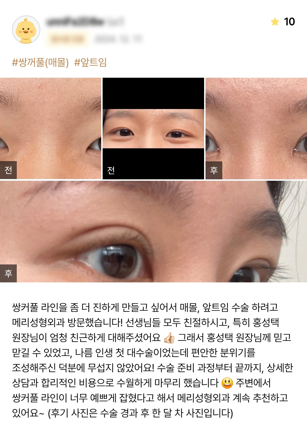 Non-incisional double-eyelid surgery and epicanthoplasty patient photo review — 186 at Merry Plastic Surgery Clinic. Non-incisional double-eyelid surgery and epicanthoplasty at Merry Plastic Surgery: before-and-after photographs shown in the supplied patient review. The source labels the follow-up as 1 month.