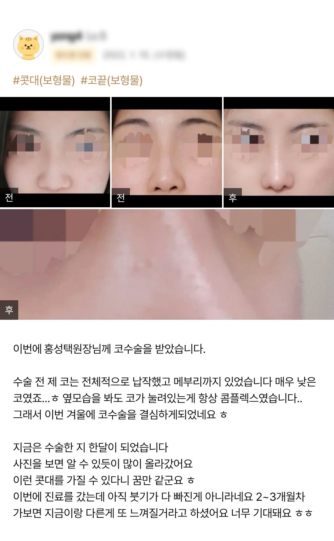 Rhinoplasty patient photo review — 190 at Merry Plastic Surgery Clinic. Rhinoplasty at Merry Plastic Surgery: before-and-after photographs shown in the supplied patient review. The source labels the follow-up as 1 month.