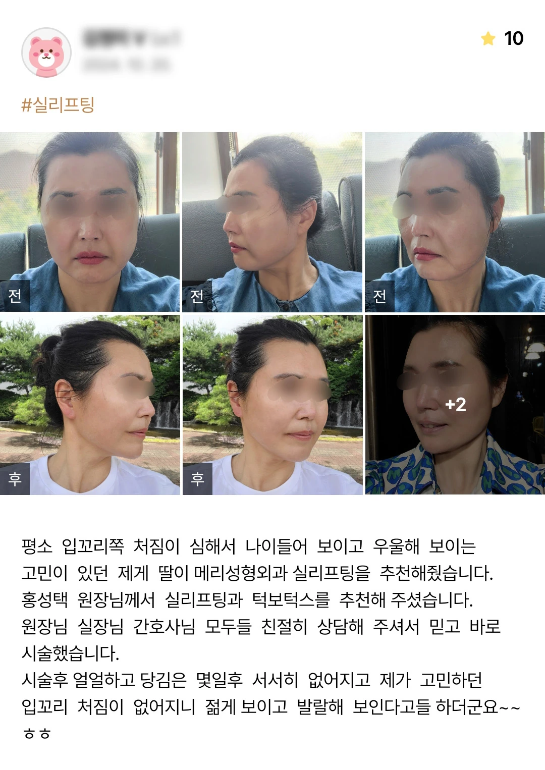 Thread lifting with botulinum toxin patient photo review — 191 at Merry Plastic Surgery Clinic. Thread lifting with botulinum toxin at Merry Plastic Surgery: before-and-after photographs shown in the supplied patient review.