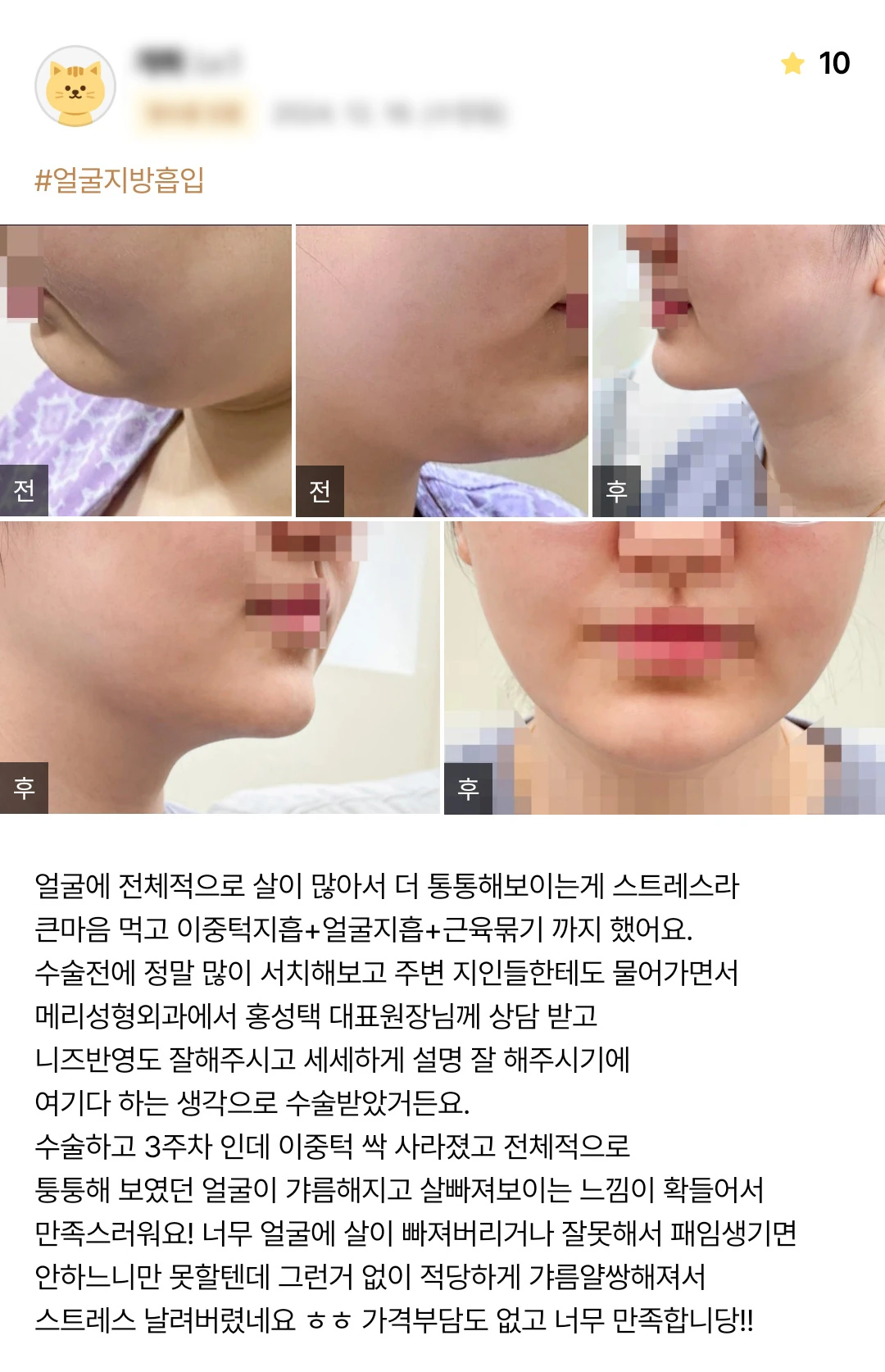 Double-chin and facial liposuction with muscle tightening patient photo review — 195 at Merry Plastic Surgery Clinic. Double-chin and facial liposuction with muscle tightening at Merry Plastic Surgery: before-and-after photographs shown in the supplied patient review.