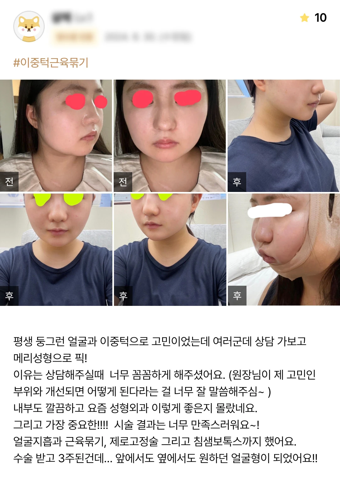 Facial liposuction, muscle tightening and botulinum toxin patient photo review — 196 at Merry Plastic Surgery Clinic. Facial liposuction, muscle tightening and botulinum toxin at Merry Plastic Surgery: before-and-after photographs shown in the supplied patient review. The source labels the follow-up as 3 weeks.