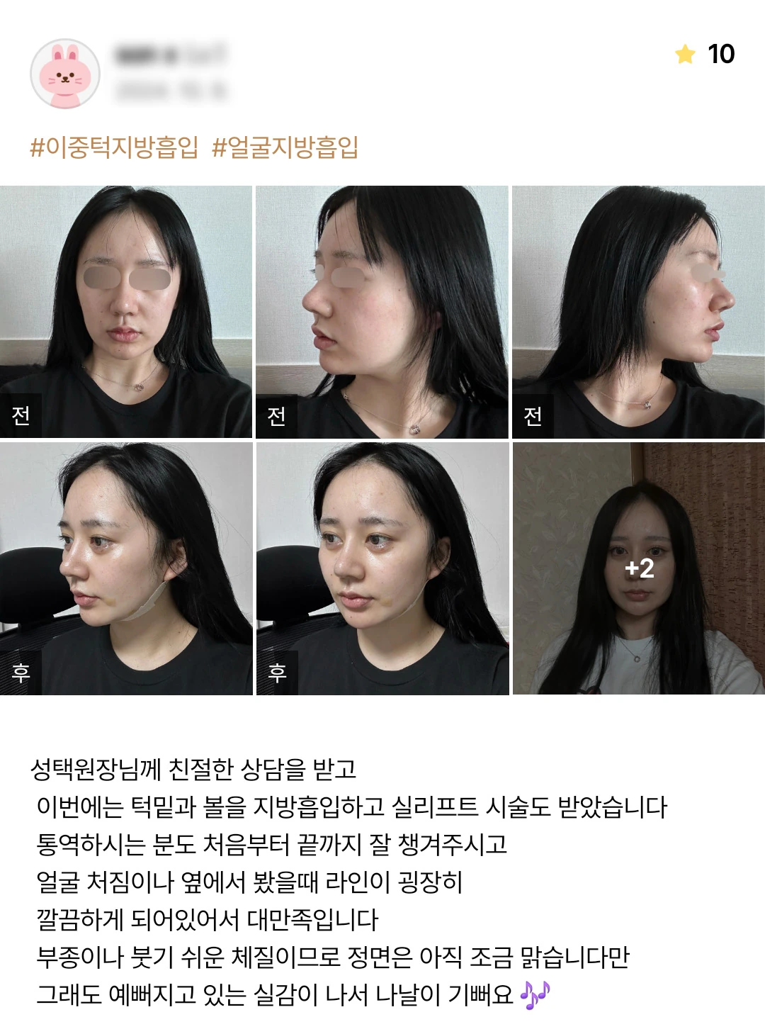 Facial liposuction and thread lifting patient photo review — 197 at Merry Plastic Surgery Clinic. Facial liposuction and thread lifting at Merry Plastic Surgery: before-and-after photographs shown in the supplied patient review.