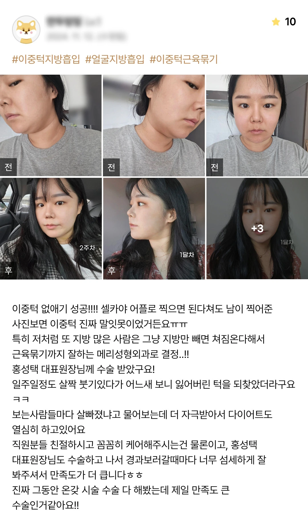 Double-chin and facial liposuction with muscle tightening patient photo review — 198 at Merry Plastic Surgery Clinic. Double-chin and facial liposuction with muscle tightening at Merry Plastic Surgery: before-and-after photographs shown in the supplied patient review.